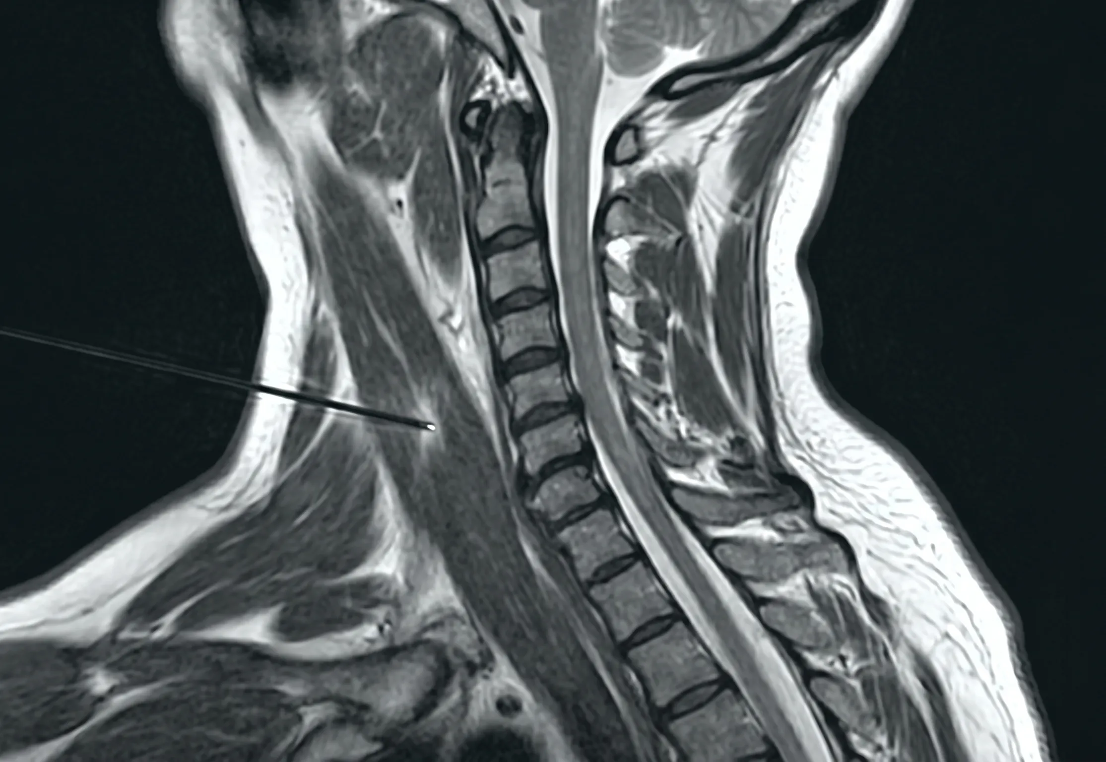 Botox for Cervical Dystonia procedure illustration