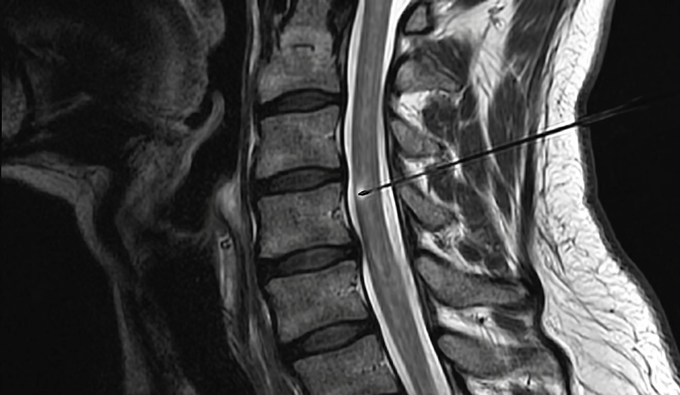 Cervical Epidural Injection procedure illustration