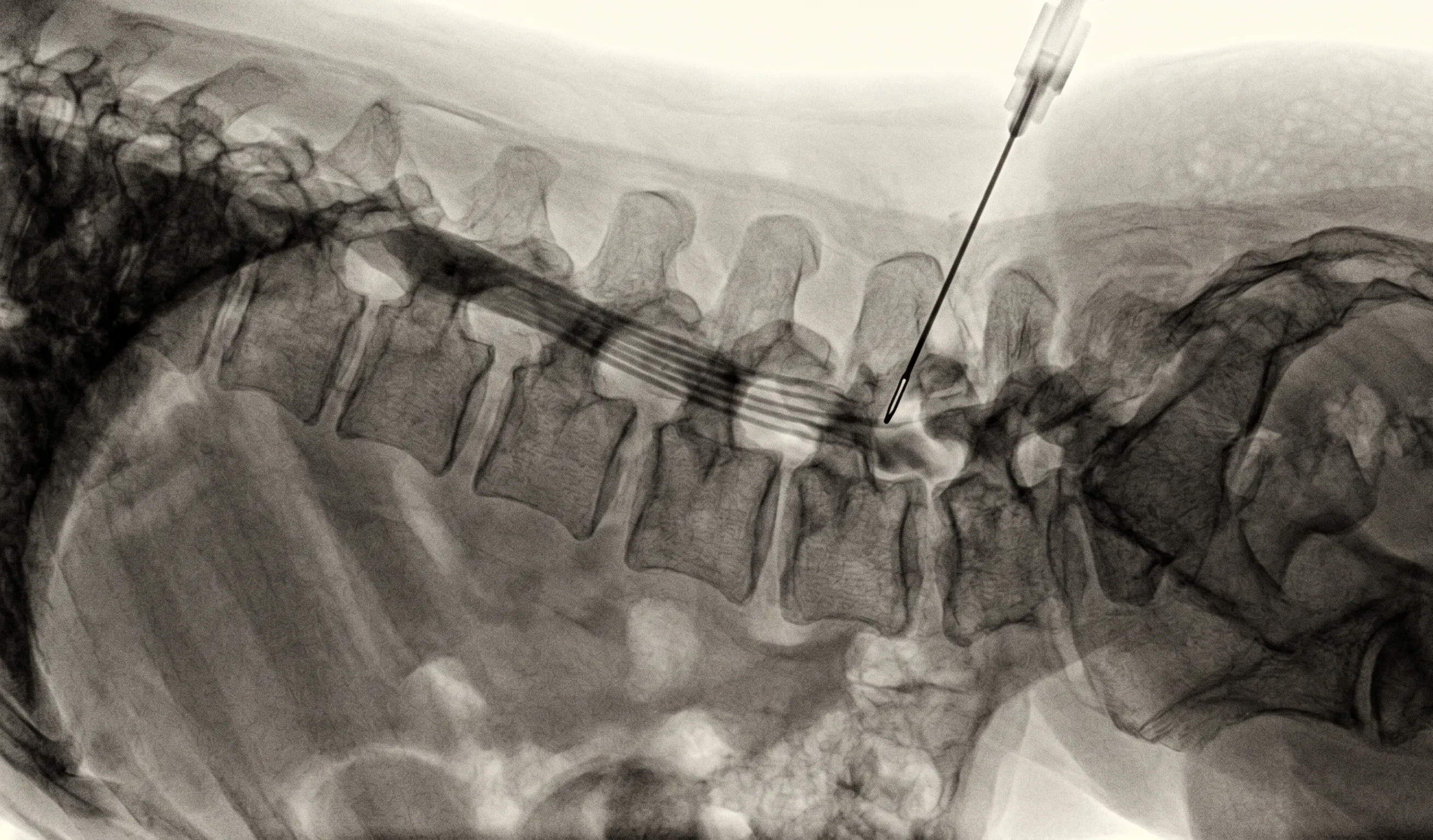 Lumbar Epidural Injection procedure illustration