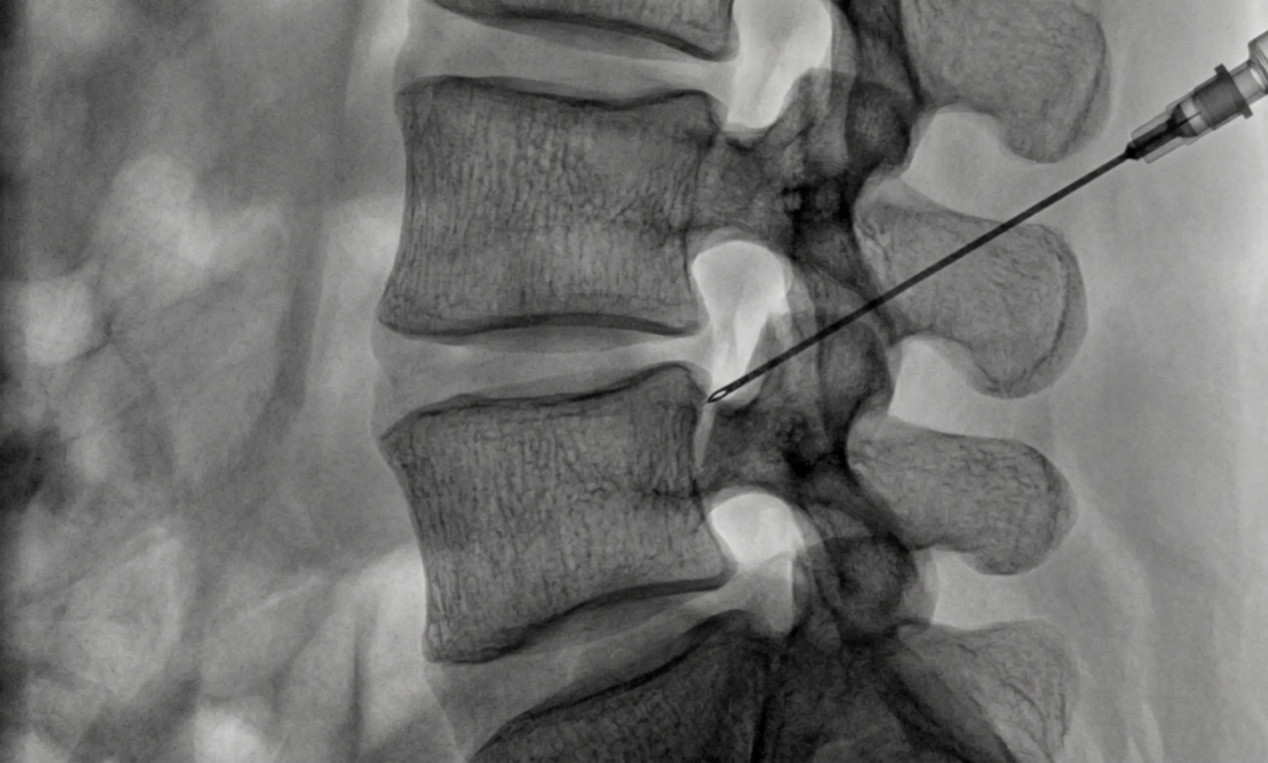 Lumbar Facet Injection procedure illustration