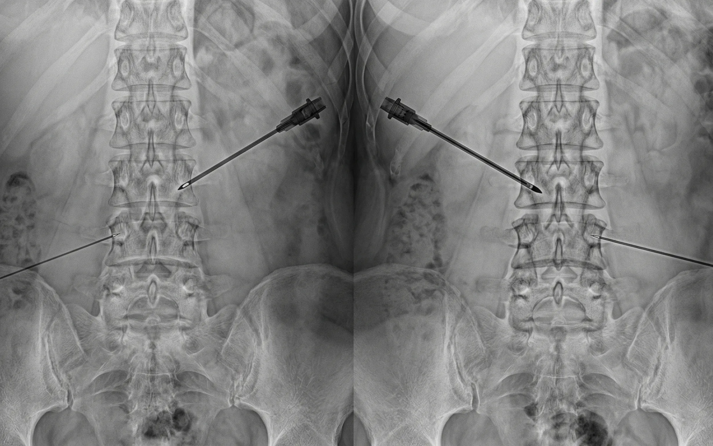 Medial Branch Block with Radiofrequency Ablation procedure illustration