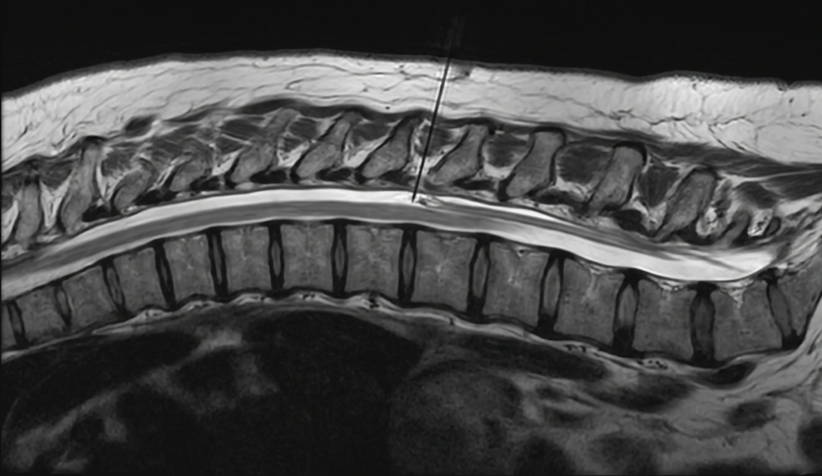 Thoracic Epidural Injection procedure illustration